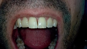 コンポジットベニアを接着した後