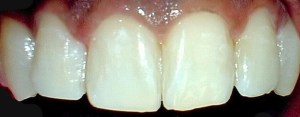 After bonded composite veneers teeth