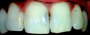 Before bonded composite veneers teeth
